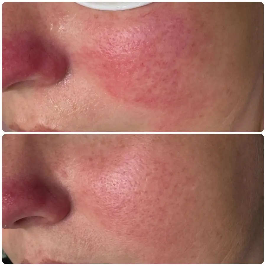 Before and after — Redness