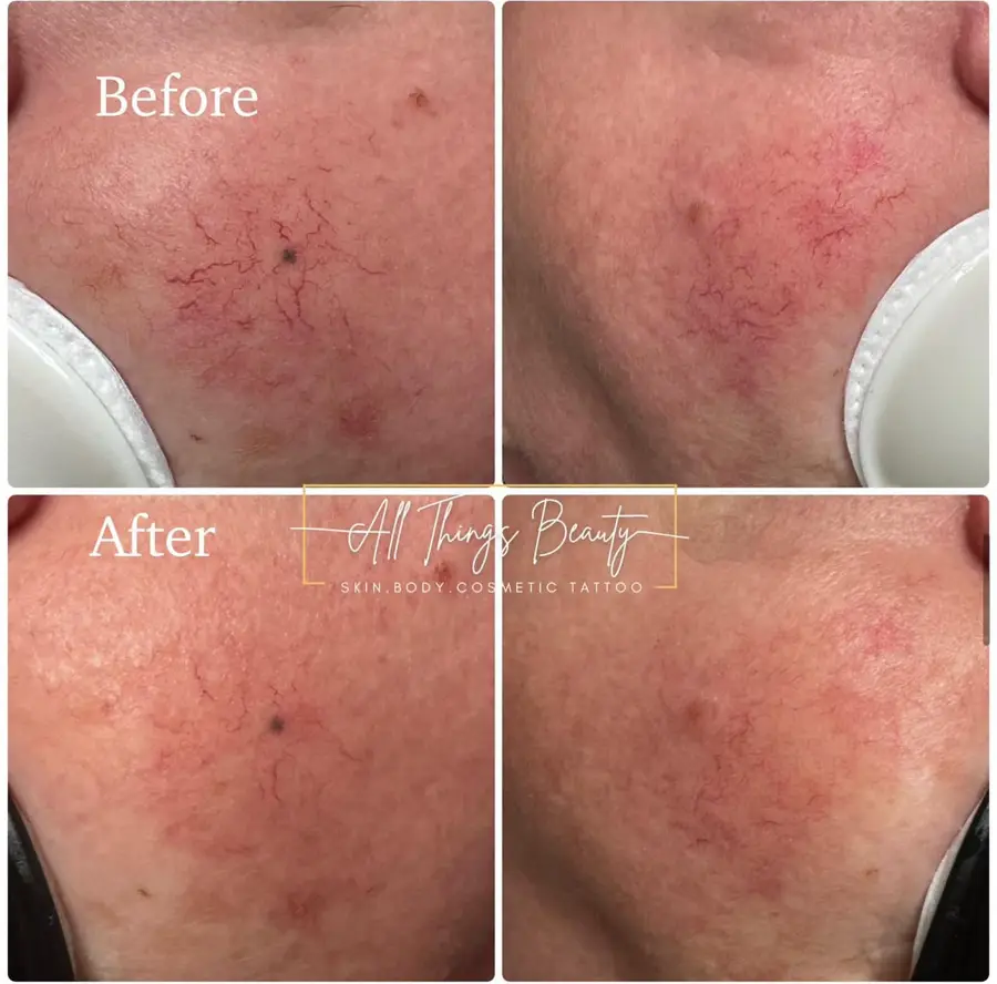 Before and after — Rosacea