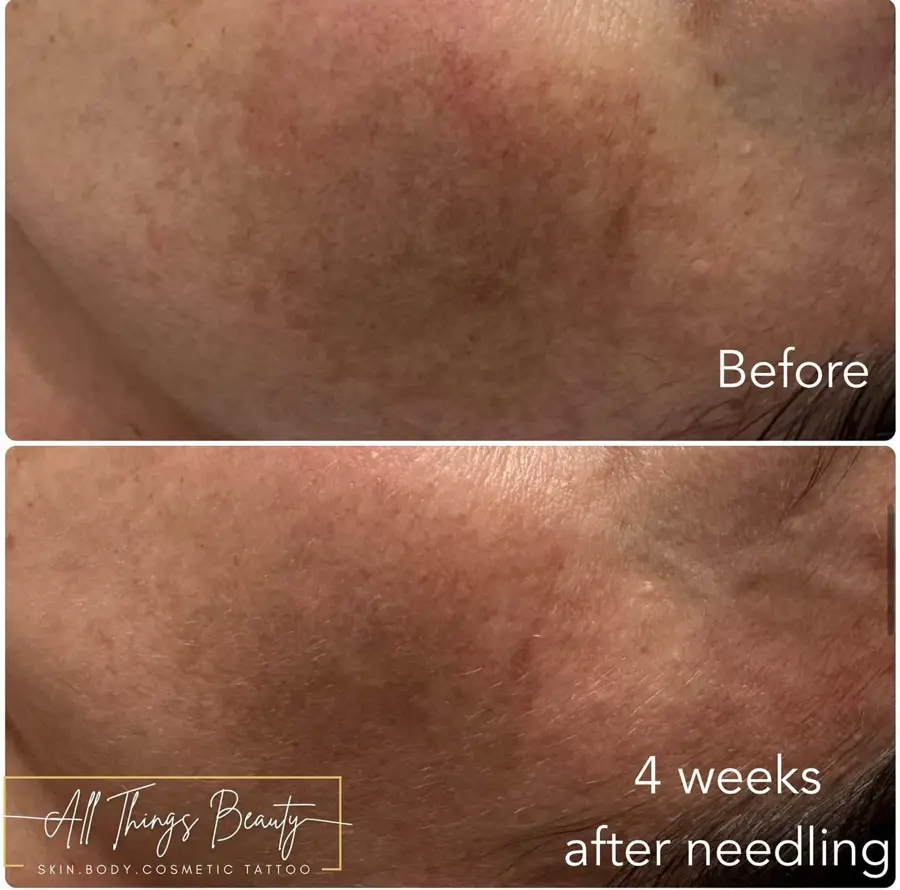 Before and after — Texture